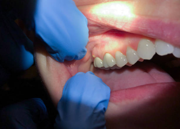 Best Emergency Dental Care for Broken or Chipped Teeth in Lewisburg, OH
